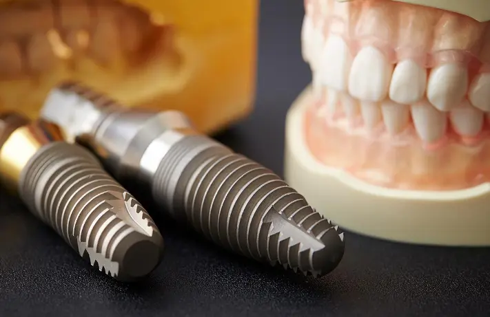 Dental implant technology