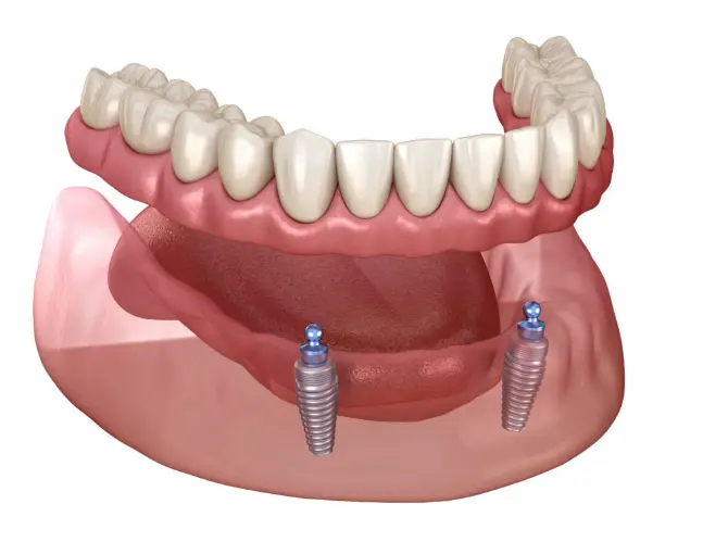 Removable dental implants