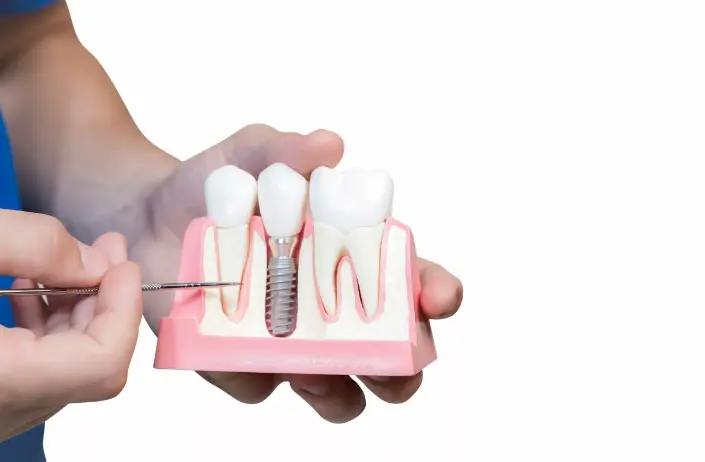 Alternative tooth implants